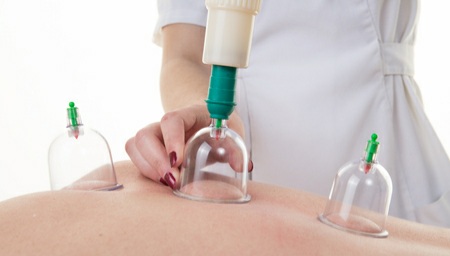 Dry cupping therapy in Bermondsey
