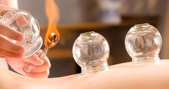 Fire cupping therapy