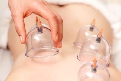 Cupping therapy in Bermondsey