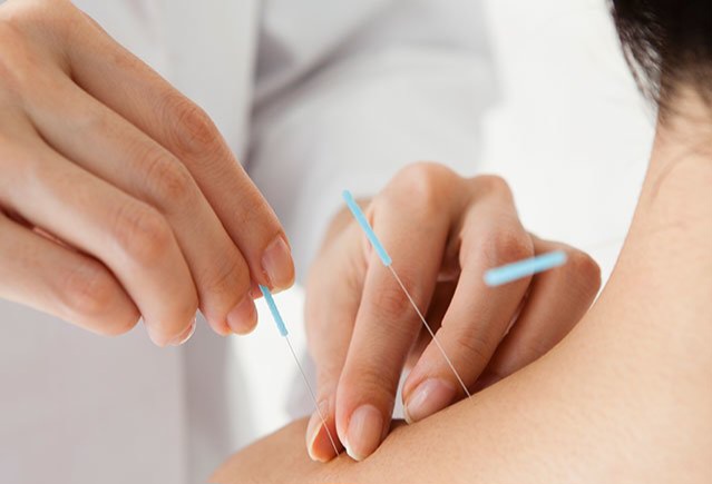 TCM acupuncture treatment in London