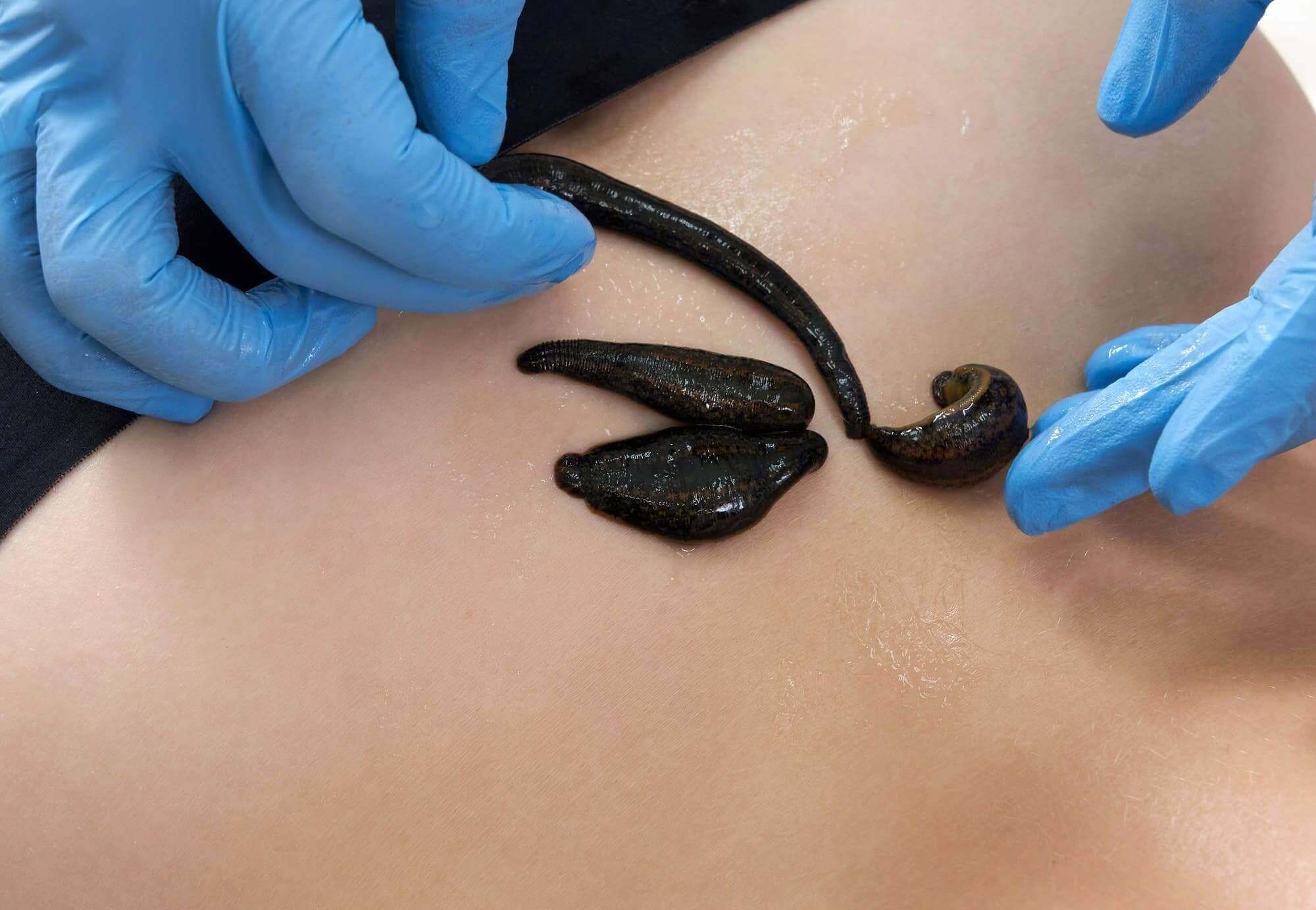 Leech Therapy (Hirudotherapy)